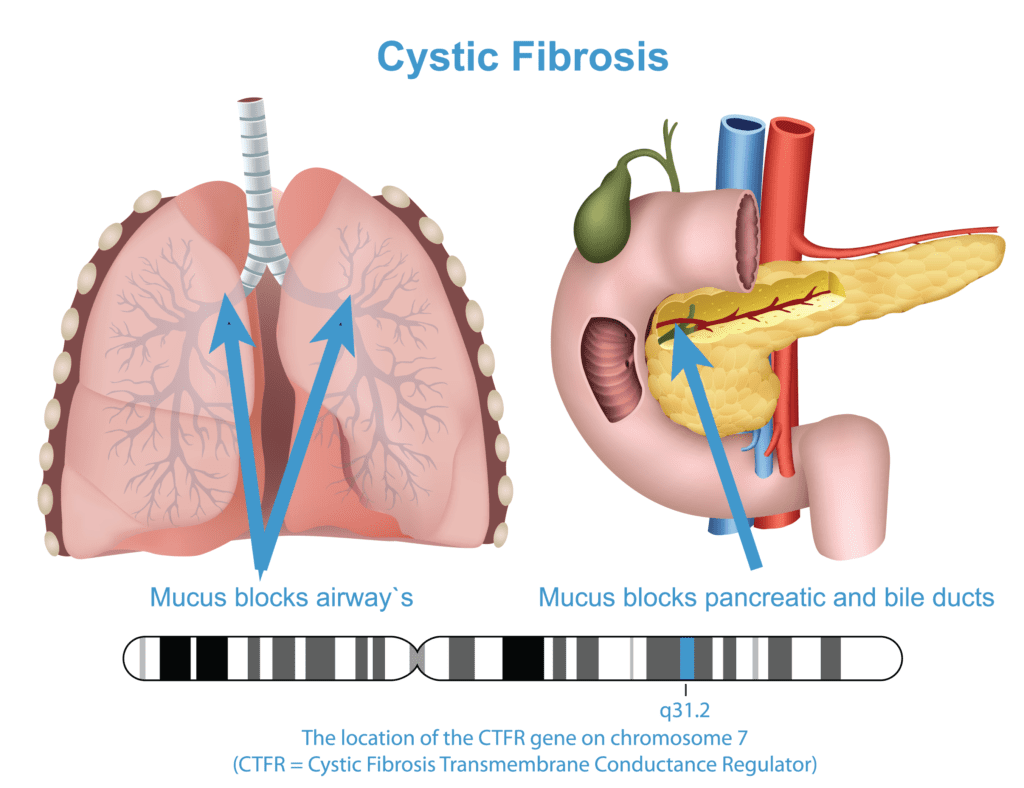 Illustration of areas affected by Cystic Fibrosis--Lungs where mucus blocks airways and intestines where mucus blocks pancreatic and bile ducts.
